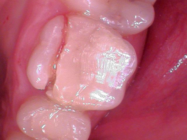 Tooth #3 - Lingual cusp is broken off.
