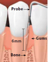 Probe shows pockets due to gum disease. Gums are inflamed and bone loss has occured.
